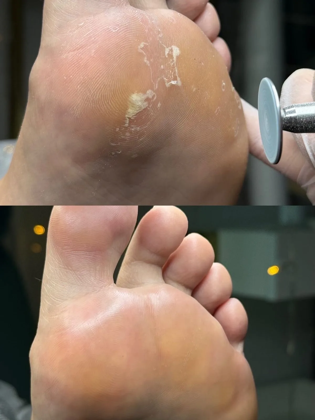 Pedicure curativo